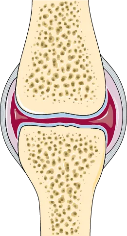 Illustration of a healthy joint with cartilage and joint lining